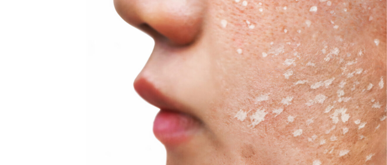 TCA Cross (Acne scars)